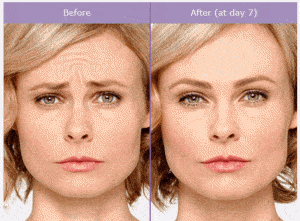Botox-Before-and-After, Vein and Skin Studio, Bayonne, NJ