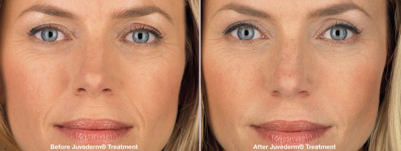 Juvederm_before_and_after_zoom