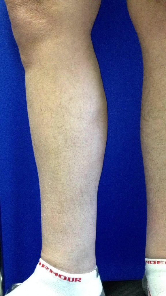After Image: Varicose Veins - left-side