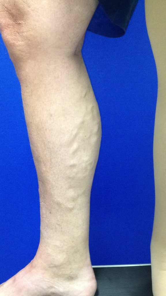 Before Image: Varicose Veins - left-side