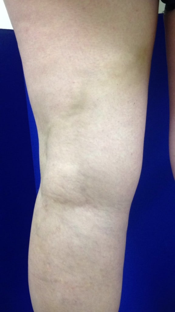After Image: Varicose Veins - back