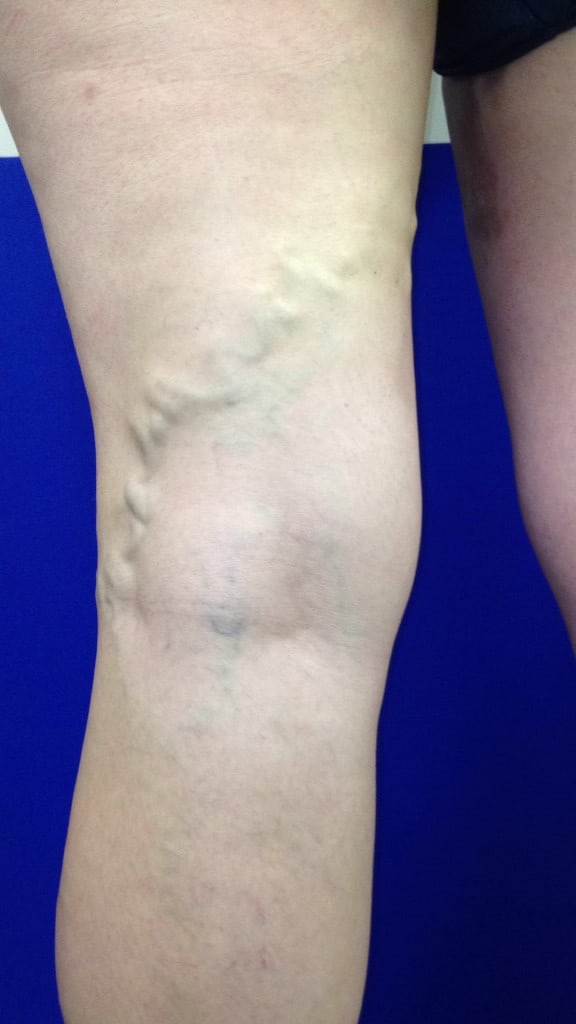 Before Image: Varicose Veins - back