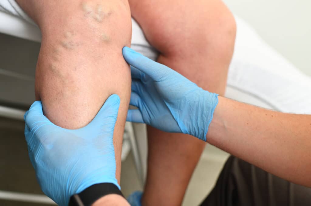 hlebologist examines a patient with varicose veins on his leg